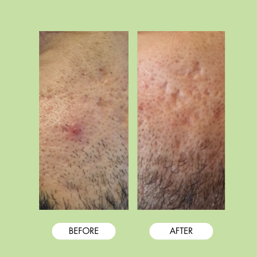 7th Heaven Men's Pimple Patches Invisible Hydrocolloid Patches with Zinc - Blemish Control & Oil Reduction