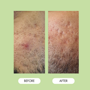7th Heaven Men's Pimple Patches Invisible Hydrocolloid Patches with Zinc - Blemish Control & Oil Reduction